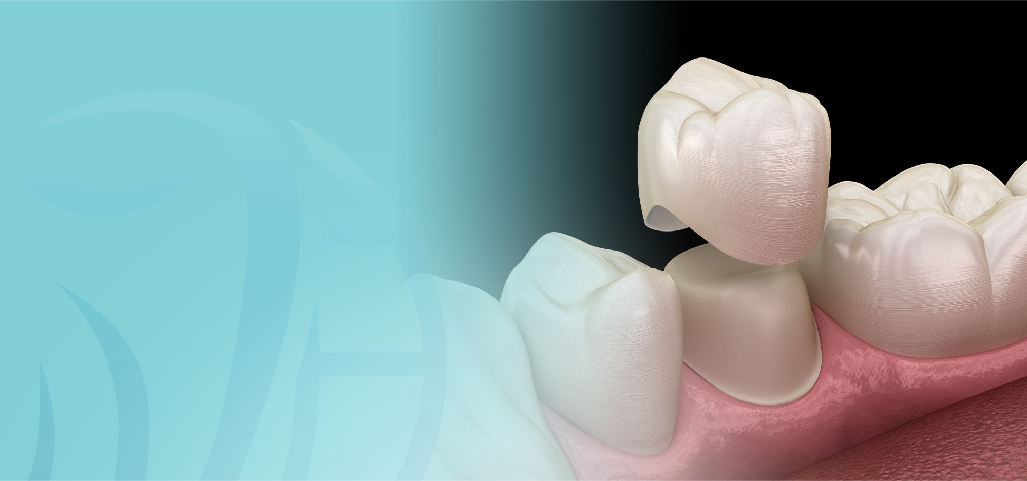 Dental Crowns Glen Innes, Glendowie, St Johns, St Heliers